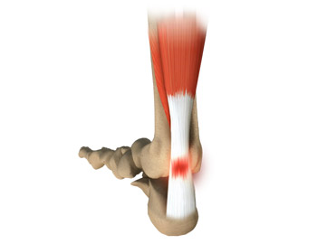Achilles Tendinosis