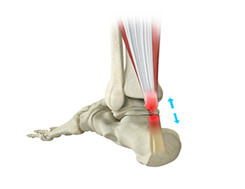 Achilles Tendon Rupture