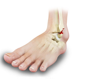Fractures of the Ankle