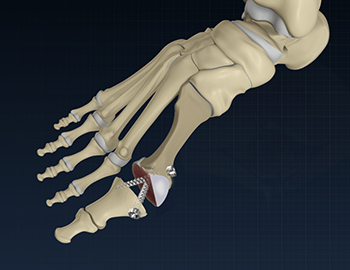 Minimally Invasive Hallux Valgus (Bunion) Correction Surgery