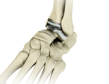 Total Ankle Arthroplasty (Ankle Replacement)